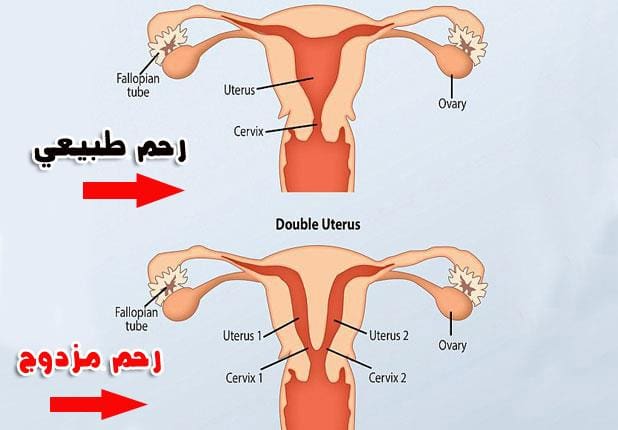 رحم مزدوج