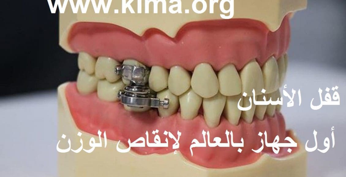 قفل الأسنان أول جهاز في العالم لإنقاص الوزن